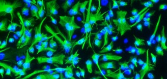 Brain-cancer-stem-cells-by-Wellcome-Images-Creative-Commons